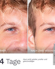 Vorher Nachher Foto eines Mannes mit Fokus auf die Stirn um den glättenden Effekt der Bergamond and Birch Hydrate 23 Anti Age Cream nach mehreren Wochen Anwendung zu zeigen.